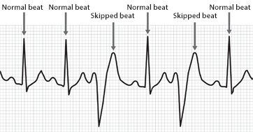 What are the types of irregular heart beats?
